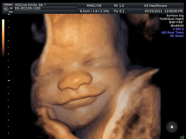 3D-скрининг при беременности - серьёзная диагностика или фото малыша на память?