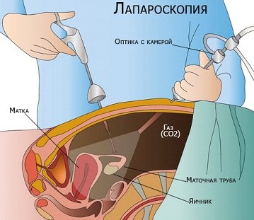 Лапароскопия матки в Нижнем Новгороде