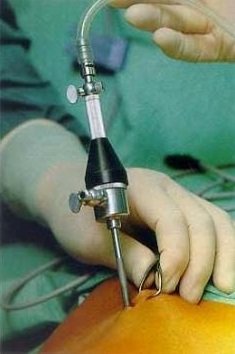 laparoskopiya-diagnostika